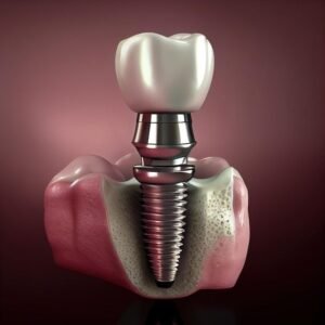 How Many Visits Are Needed for Dental Implants?